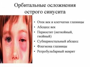 Синусит У Детей Симптомы И Лечение Комаровский