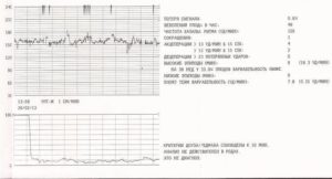 Нормы ктг на 38 неделе беременности