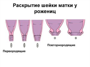 Раскрытие на 2 пальца и отошла пробка когда рожать