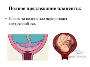 Плацента по задней стенке матки перекрывает внутренний зев
