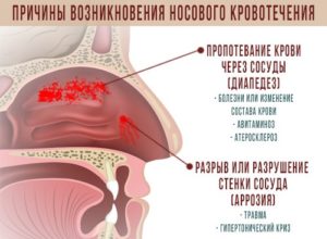 Признак беременности кровь из носа