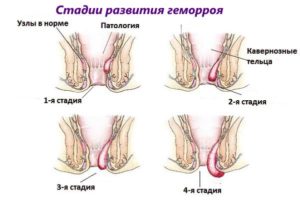 После родов вылезла кишка из заднего прохода