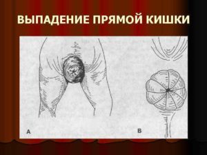 После родов вылезла кишка из заднего прохода