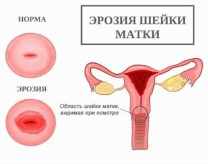 Кровит шейка матки при беременности после осмотра