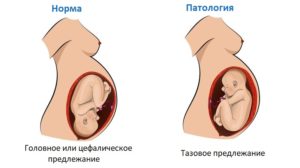 32 неделя беременности тазовое предлежание что делать