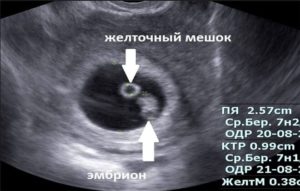 При каком хгч видно эмбрион и сердцебиение на узи