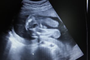 Узи 21 неделя беременности фото мальчика