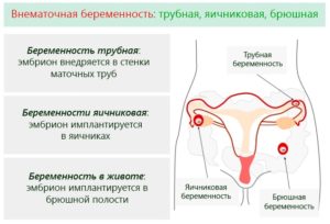 Выделения При Внематочной Беременности На Ранних Сроках