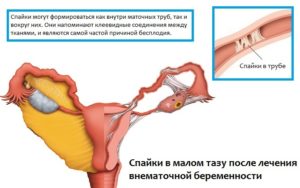 Температура После Внематочной Беременности После Операции