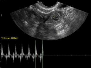 Внематочная беременность 6 7 недель