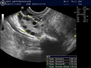 Увеличен яичник при беременности на ранних сроках