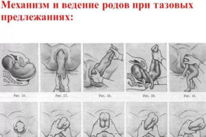При тазовом предлежании можно ли рожать самой
