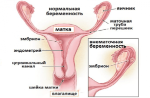 При внематочной беременности матка увеличивается