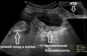 8 Недель внематочной беременности