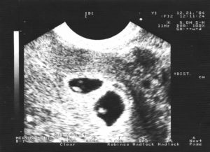 Двойня узи 5 недель беременности фото