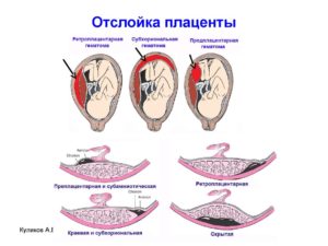 Отслойка плаценты на 8 неделе беременности причины и последствия