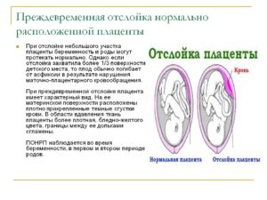 Отслойка плаценты на 8 неделе беременности причины и последствия