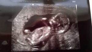 18 Недель беременности гипертонус
