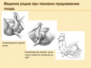 При тазовом предлежании можно ли рожать самой