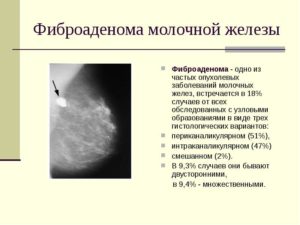 Нужно ли удалять фиброаденому молочной железы при менопаузе