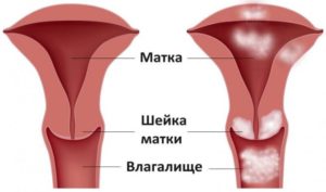 Прострелы в шейке матки при беременности