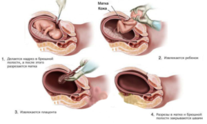 Симптомы расхождения шва на матке после кесарева во время беременности