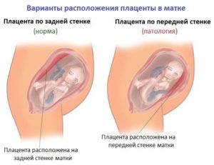 Дюфастон При Отслойке Плаценты В Первом Триместре