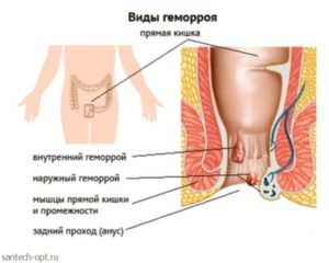 После родов колит в заднем проходе