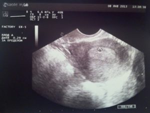 3 недели от зачатия узи покажет беременность