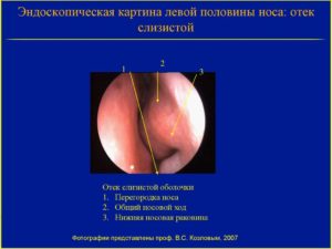 Отек слизистой носа лечение при беременности