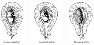 Тянет матку при беременности на ранних сроках