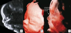 У плода гипоплазия носовых костей