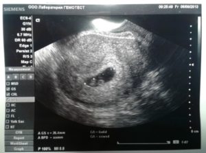 Гипертонус матки 6 недель беременности