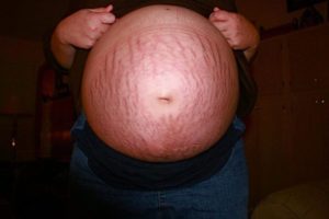 На каком месяце беременности появляются растяжки на животе