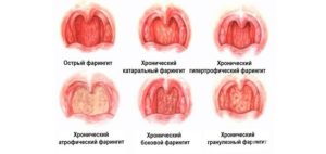 Вирусный Фарингит Симптомы И Лечение У Детей