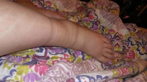 Отеки ног на 36 неделе беременности