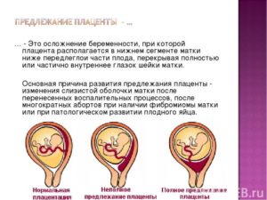 Низкая плацентация при беременности 18 неделя