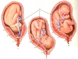 Краевое предлежание плаценты что значит
