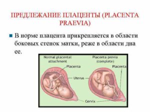 Плацента по задней стенке матки с переходом на дно