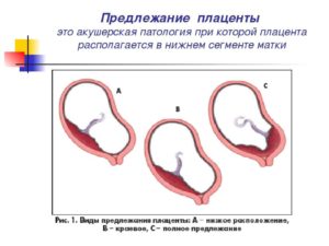 Краевая Плацентация При Беременности Опасно Или Нет