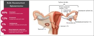 Растет матка при внематочной беременности