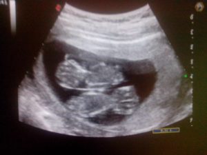 Двойня 15 недель беременности фото