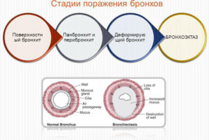 Чем лечить бронхит при беременности 1 триместр