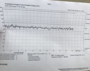 Неделю не чувствую шевелений. На КТГ ребенок не шевелится. КТГ при беременности гипоксия. КТГ не при беременности. Гипоксия плода при беременности на КТГ.