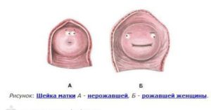 Шейка матки после родов не закрылась