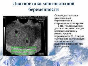 Признаки двойни на ранних сроках беременности без узи форум