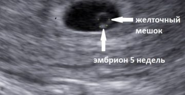 Желточный мешок есть а эмбриона не видно 6 недель