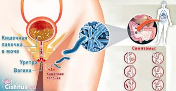 Кишечная палочка при беременности в моче отзывы