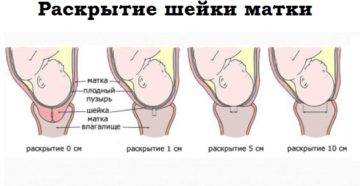 Симптомы раскрытия шейки матки при беременности во втором триместре