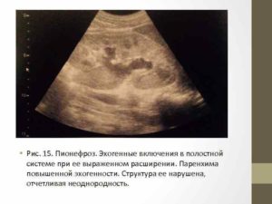 Повышенная эхогенность плаценты при беременности